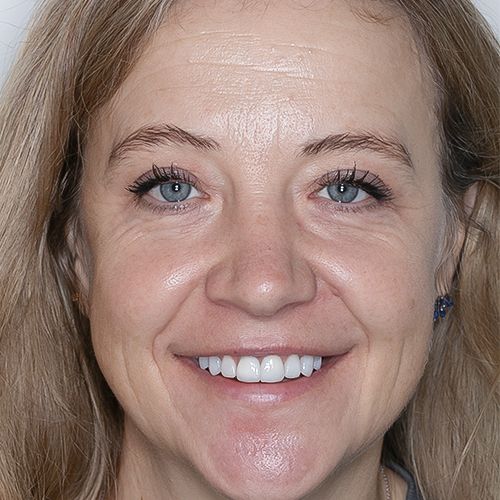 Maiely - composite veneers - after - Carmen - 3dental